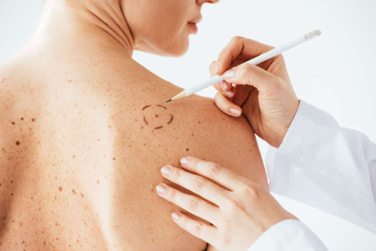 Warts Skin Tag and Mole Removal Clínica Elite Palma