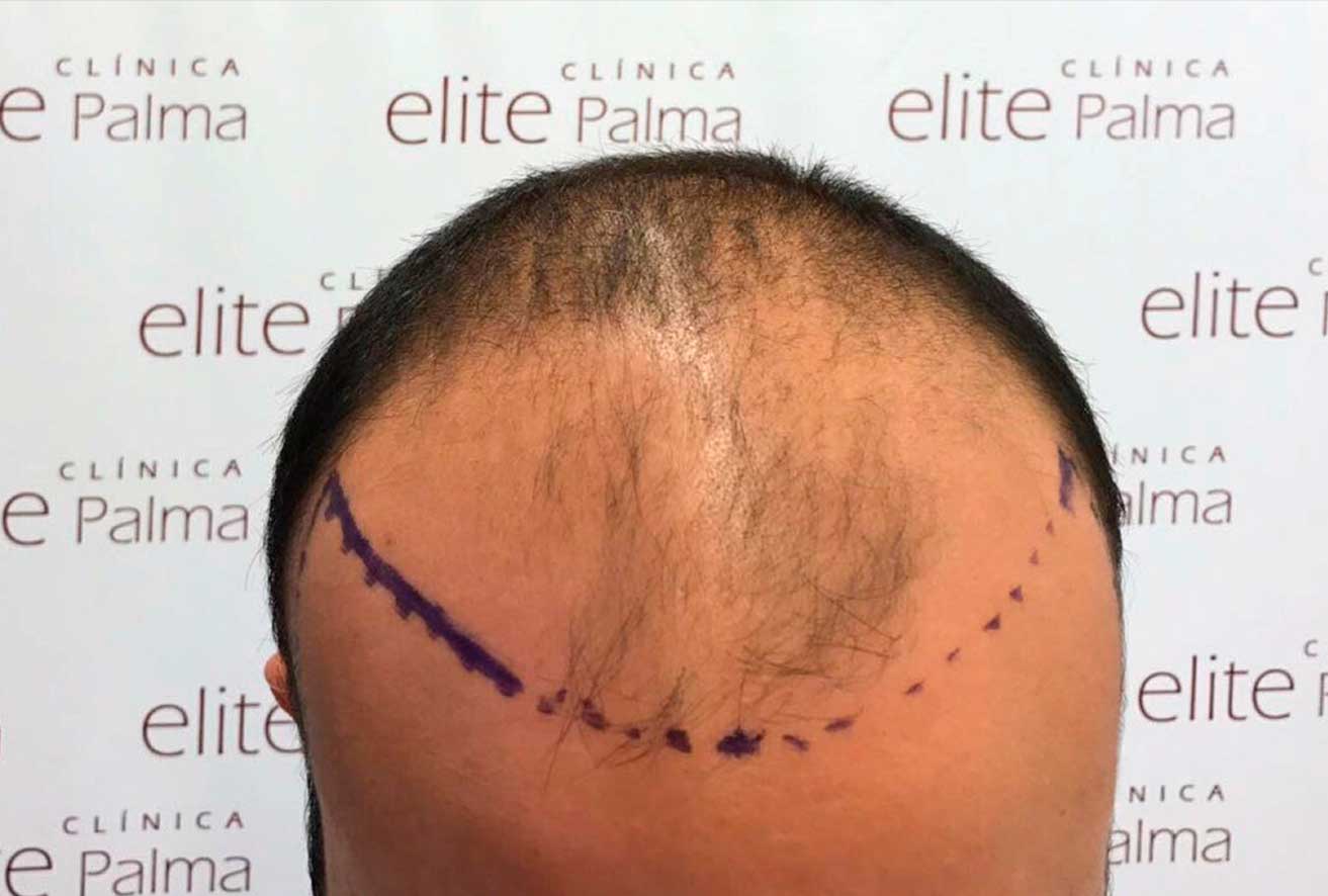 Haartransplantation mit der FUE Technik
