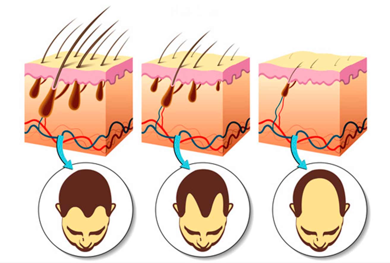 Grados de Alopecia y vida del folículo