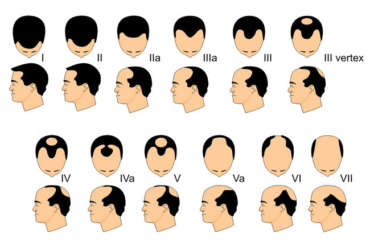 Degrees of Alopecia and follicle life - Clínica Elite Palma