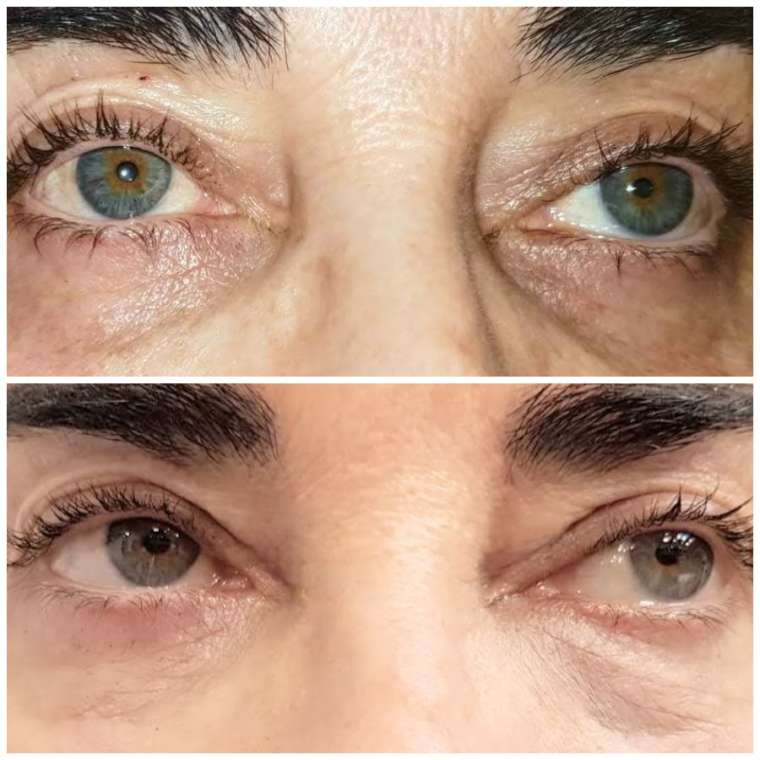 Dark Circles Treatment Elite Palma