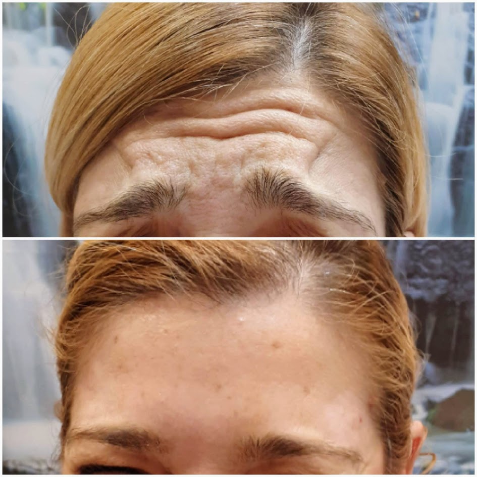 Antes y después del tto de Rejuvenecimiento Facial con Neuromoduladores - Elite Palma