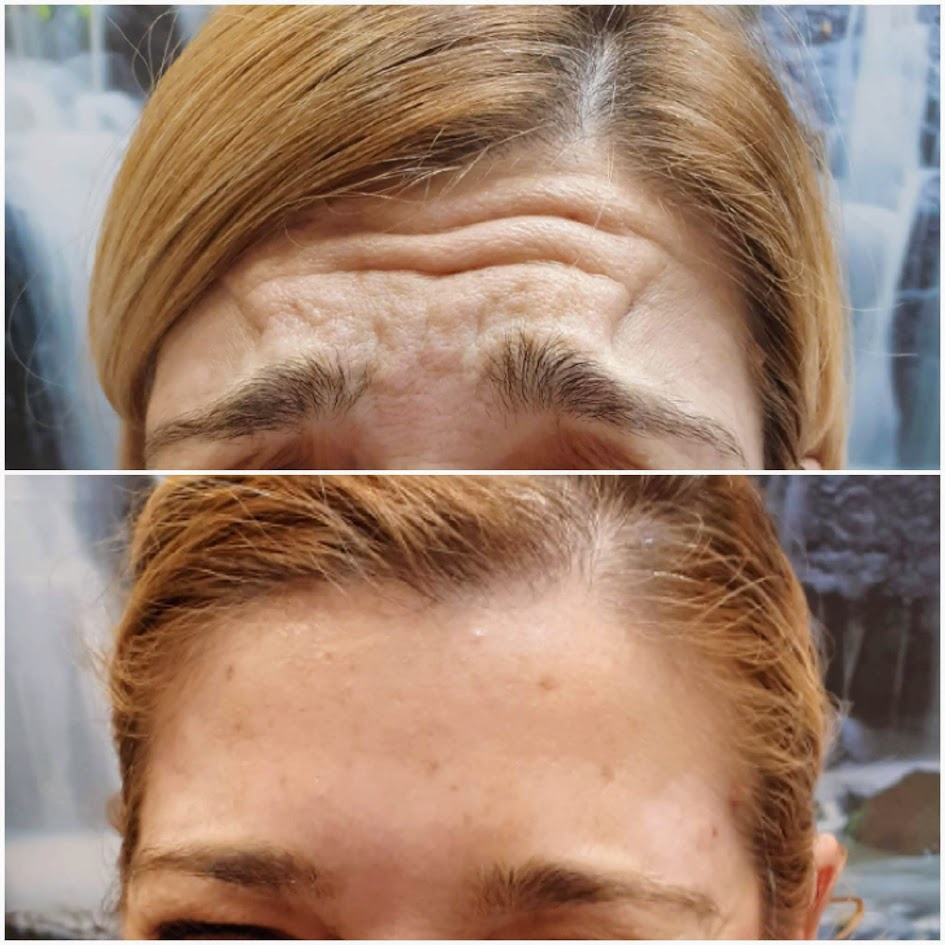 Toxina Botulínica - Botox - Elite Palma