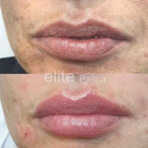 Estética-Labial-corrige asimetrías de tus labios