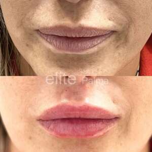 hidratación de labios con resultados naturales