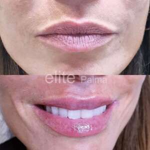 Estética-Labial-proyecta tus labios