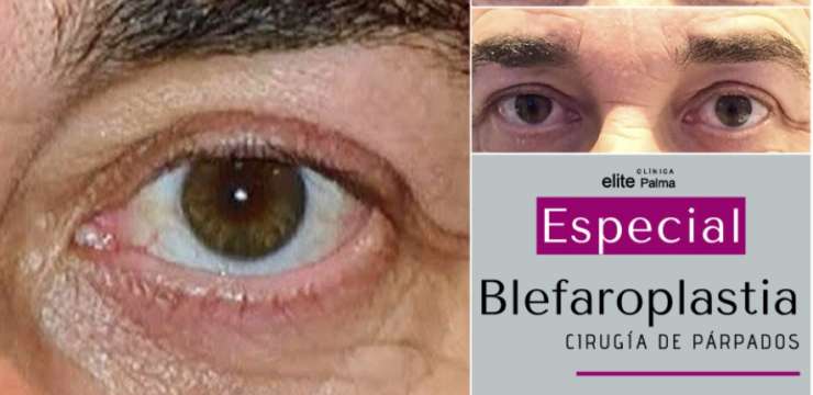 Campaña-Blefaroplastia-Febrero-en-Mallorca-Elite-Palma-2020