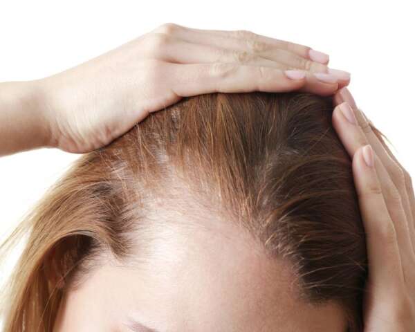 Alopezie bei Frauen