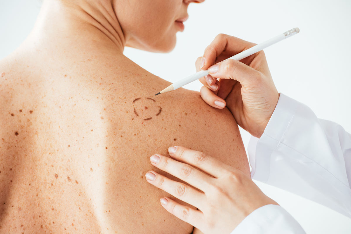 Warts Skin Tag and Mole Removal